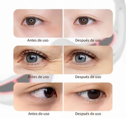 LumiEyes™ - Gafas Terapéuticas